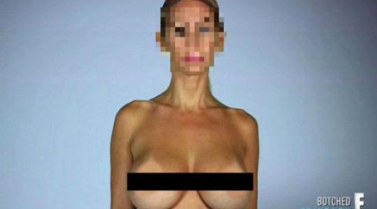 Οι ρώγες του τρόμου: Το πασίγωνστο κουνελάκι του Playboy και η πλαστική εγχείρηση στο στήθος που πήγε στραβά (PHOTOS)